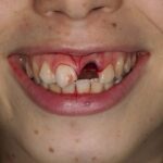 dente caduto