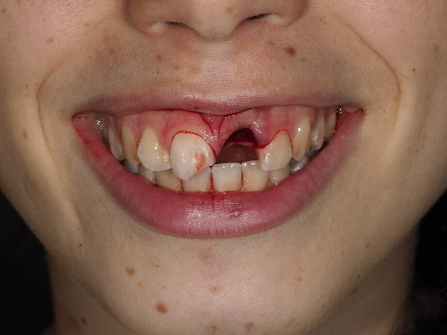 dente caduto