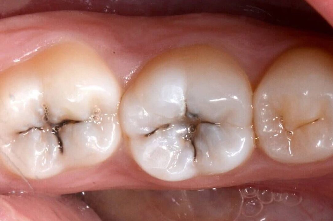 dente cariato 1