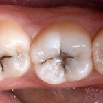 dente cariato 1
