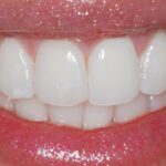 denti bianchi 1