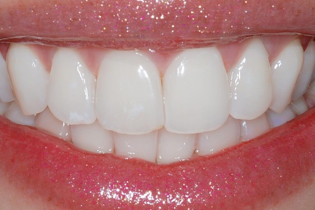 denti bianchi 2