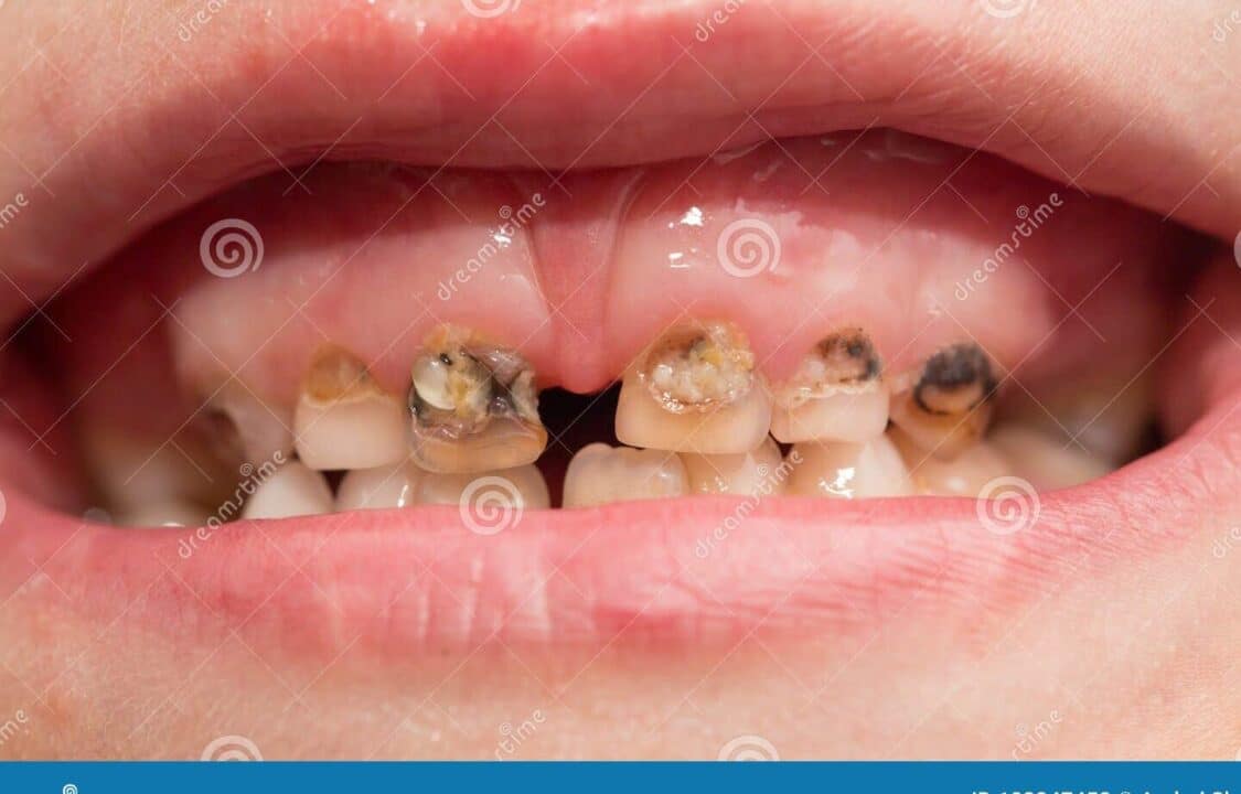 denti marci 2
