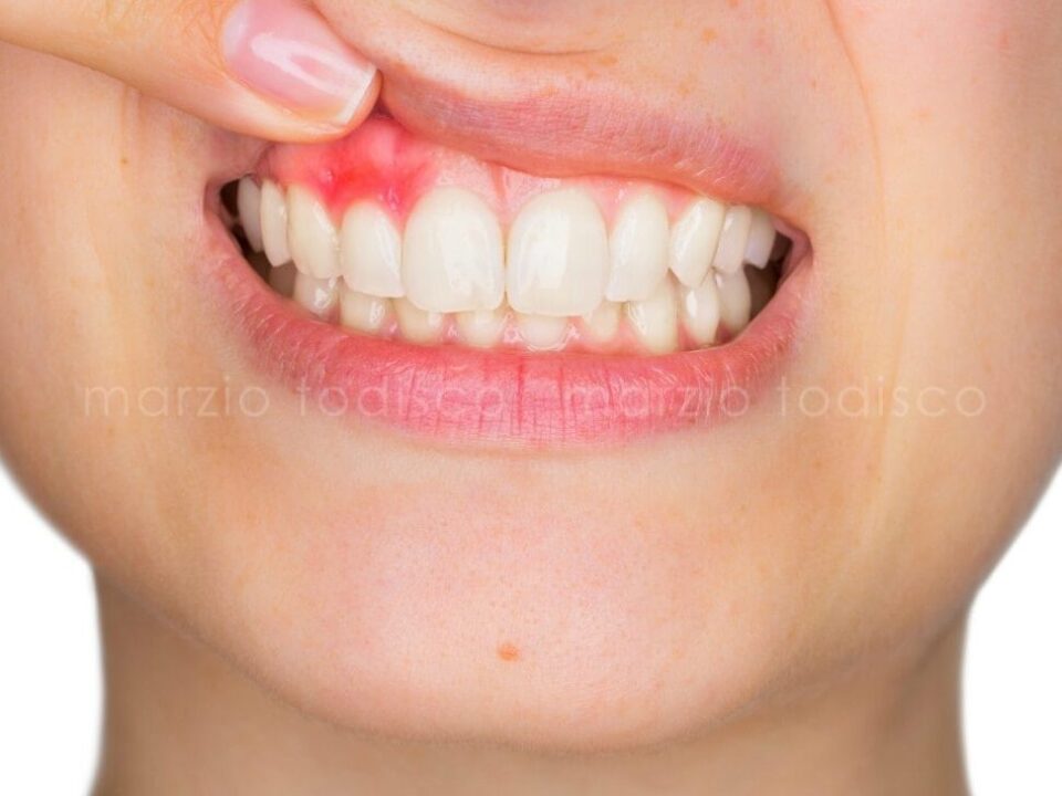 denti sanguinano